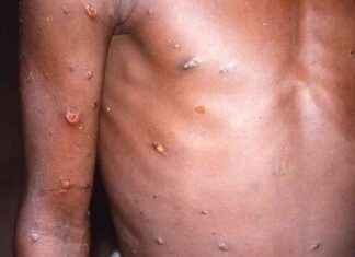 First Case of Deadly MPOX Clade Ib Discovered in London – London Business Update | LondonLovesBusiness news-31102024-021805